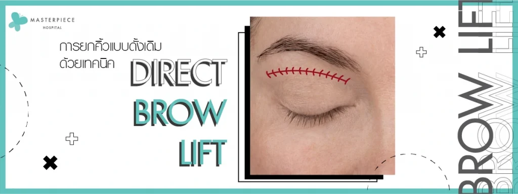 direct brow lift