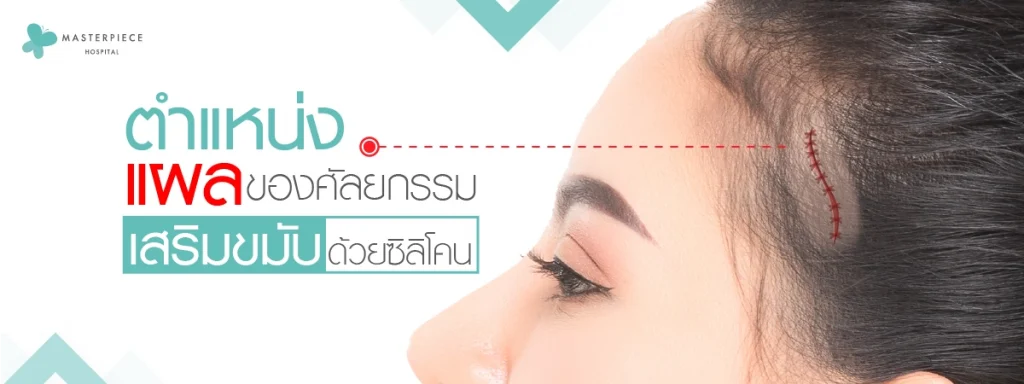 ตำแหน่งแผลของศัลยกรรม