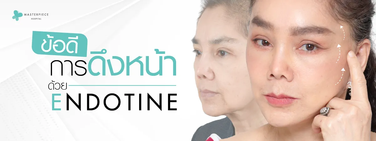 ข้อดีของการ ดึงหน้า ด้วย Endotine